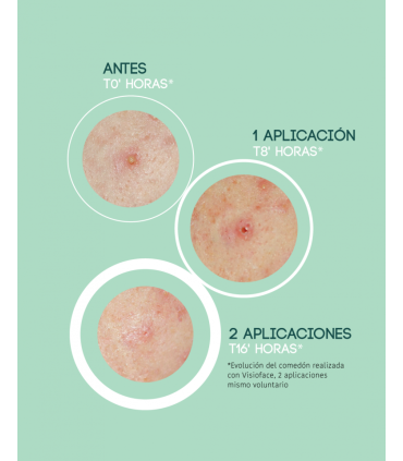 Parches Granos SOS Ácido Salicílico 🩹 Iroha Pro