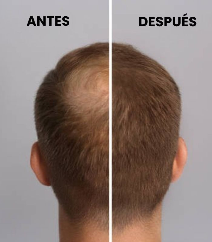 InLab Exohair Plus: Viales Anticaída Exosomas 💆‍♀️✨