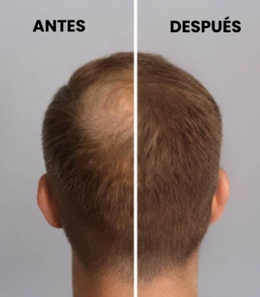 InLab Exohair Plus: Viales Anticaída Exosomas 💆‍♀️✨